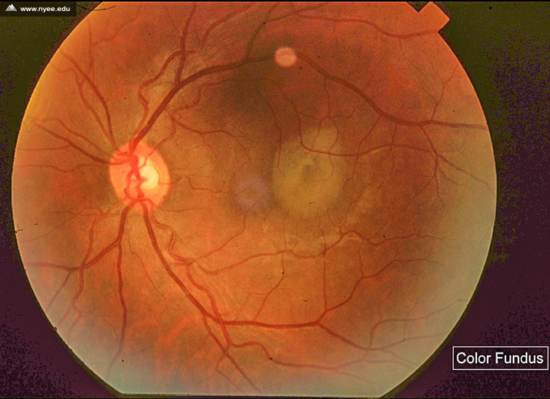 CSR Central Serous Retinopathy Chronic (1 of 10) - NYEE