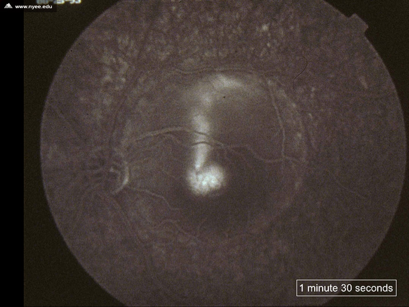 CSR Central Serous Retinopathy Chronic (2 of 10) - NYEE