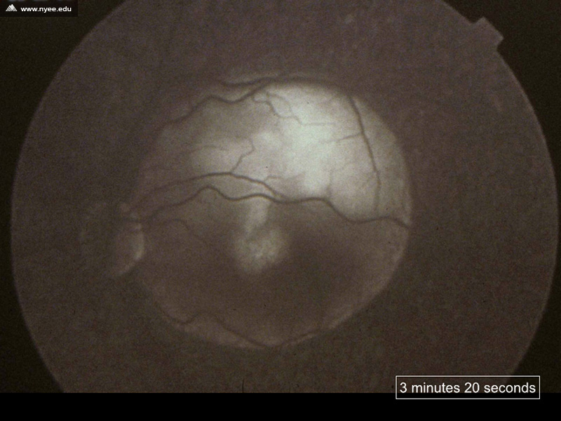 CSR Central Serous Retinopathy Chronic (4 of 10) - NYEE