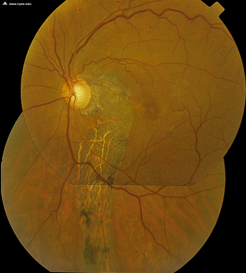 CSR Central Serous Retinopathy Chronic (10 of 10) - NYEE