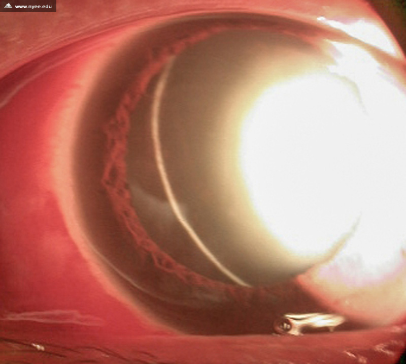 Dislocated Cristallin Lens Posterior (1 of 3) - NYEE