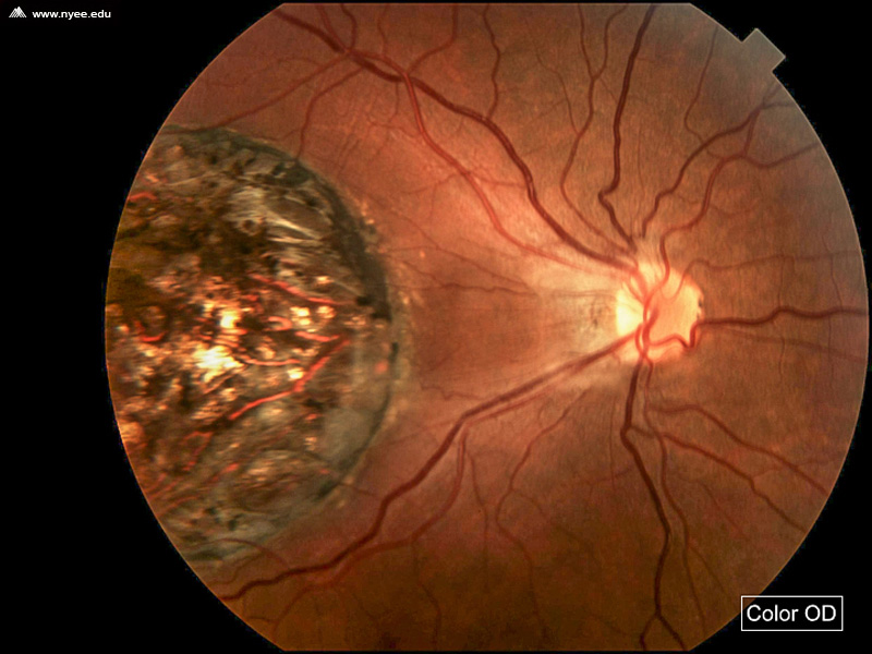 Macular Coloboma (1 of 4) - NYEE