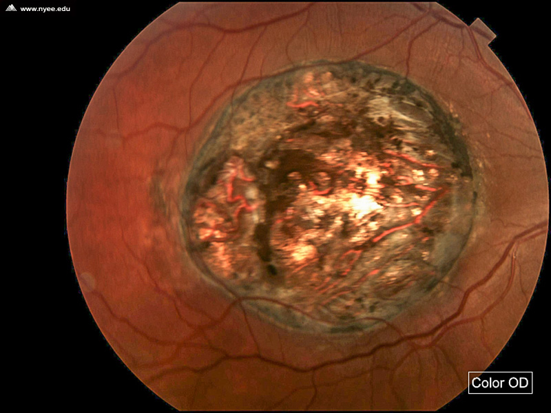 Macular Coloboma (2 of 4) - NYEE