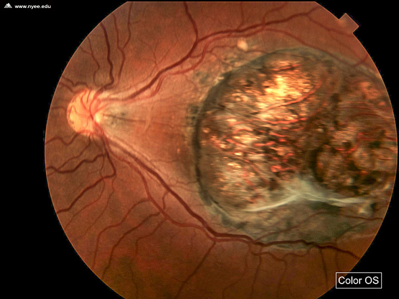 Macular Coloboma (4 of 4) - NYEE