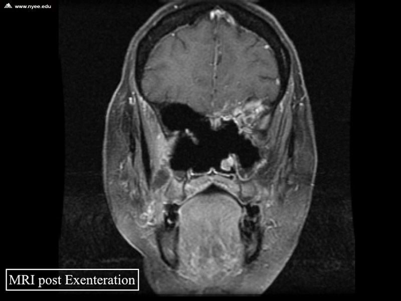 Rhino Orbital Cerebral Mucormycosis (8 of 12) - NYEE