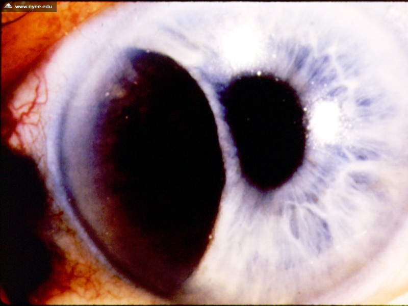 Ciliary Body Melanoma with Extrascleral Extension - NYEE