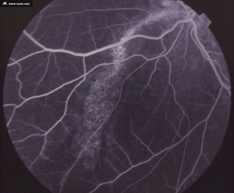 CSR Central Serous Retinopathy Chronic (6 of 10) - NYEE