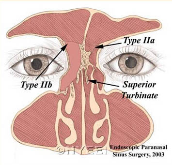 Frontal Sinusotomy Surgical Technique - NYEE