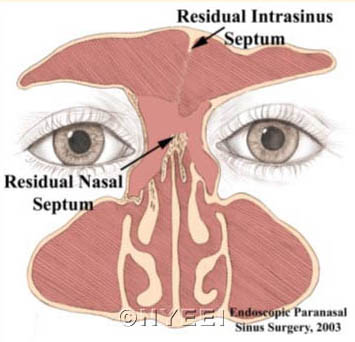 Frontal Sinusotomy Surgical Technique - NYEE